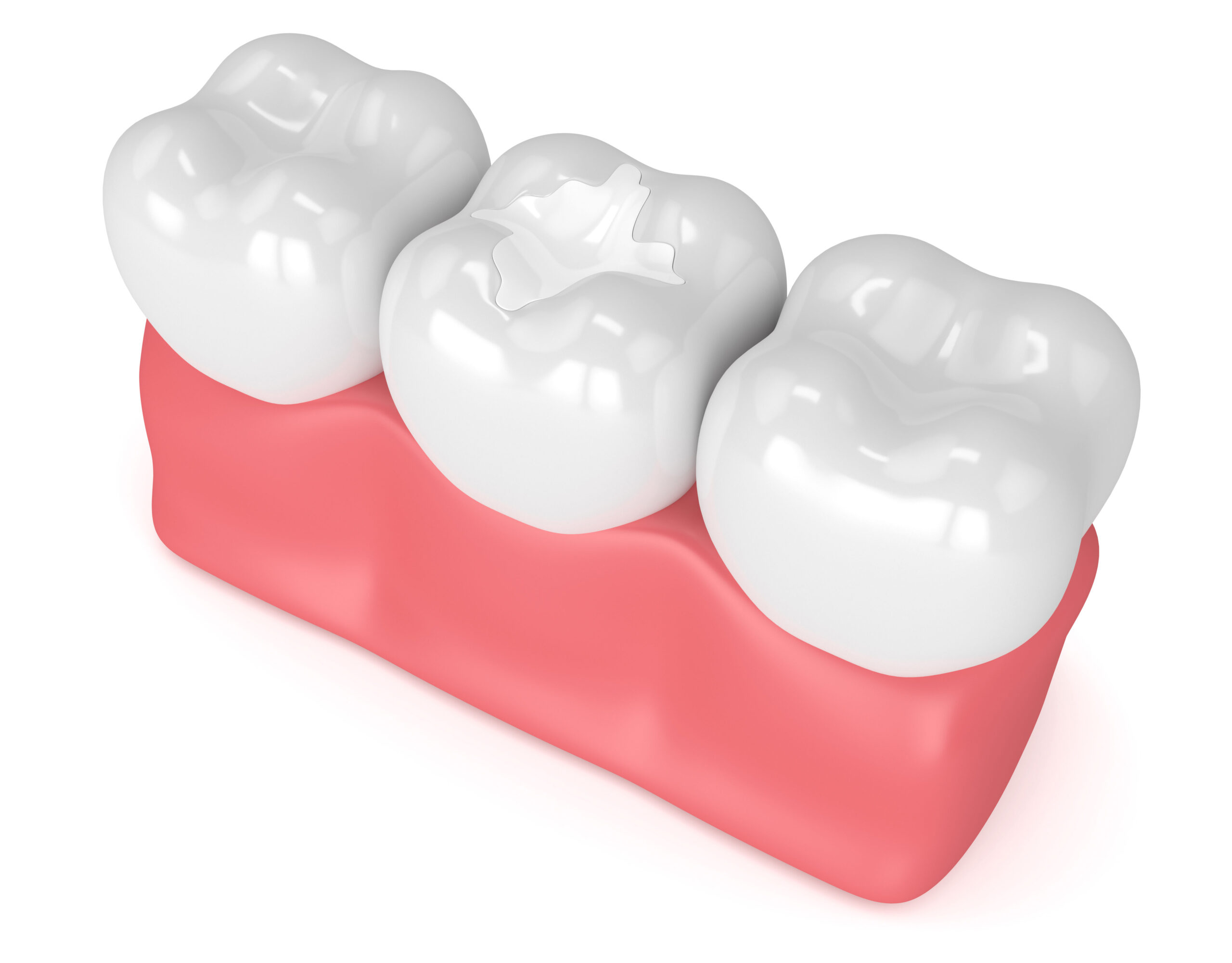 What is a Composite Filling?